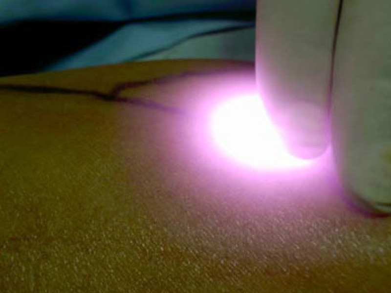 Laser endovascolare di varici periferiche